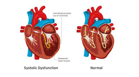 systolic dysfunction without heart failure